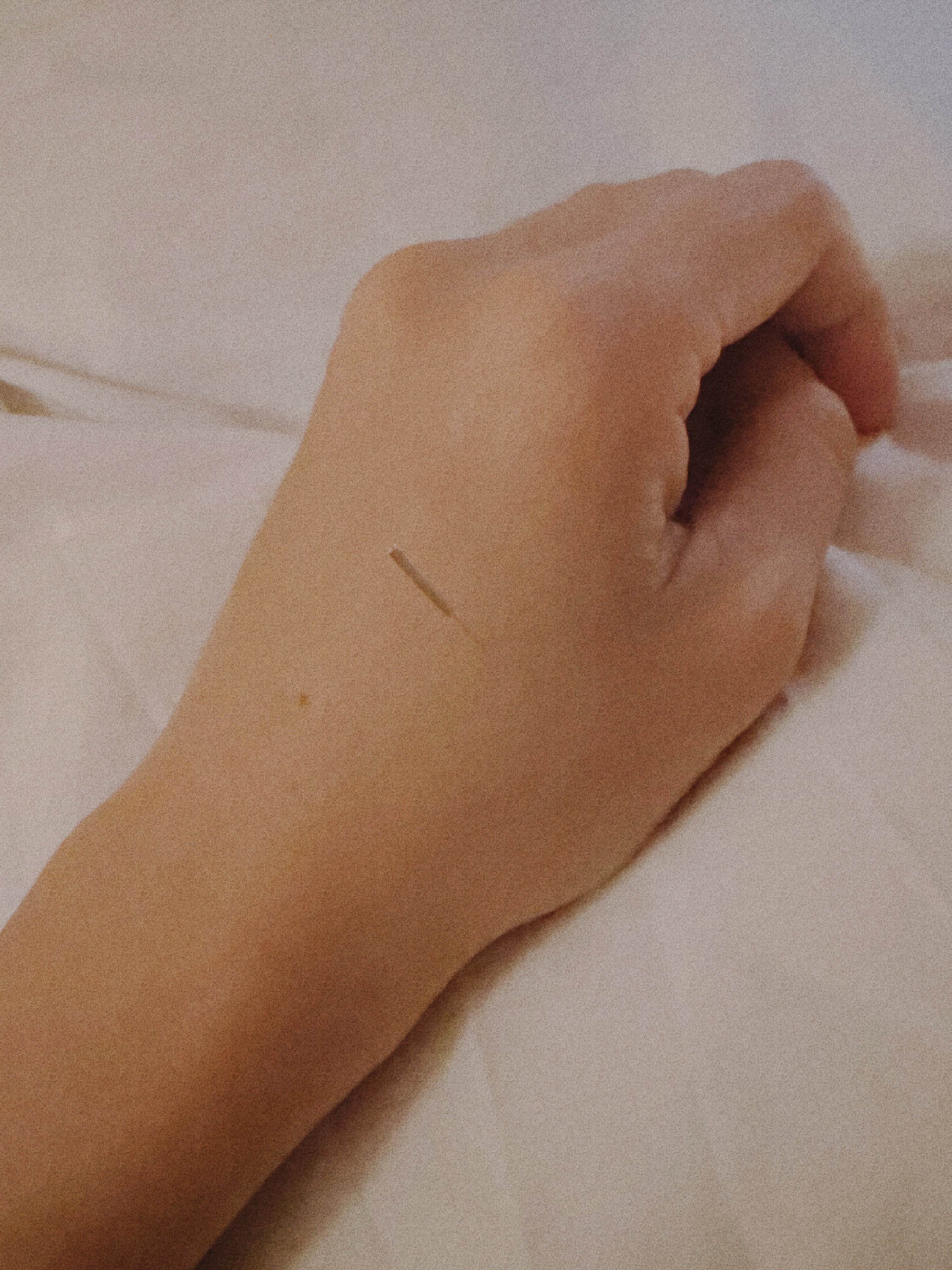 Acupuncture