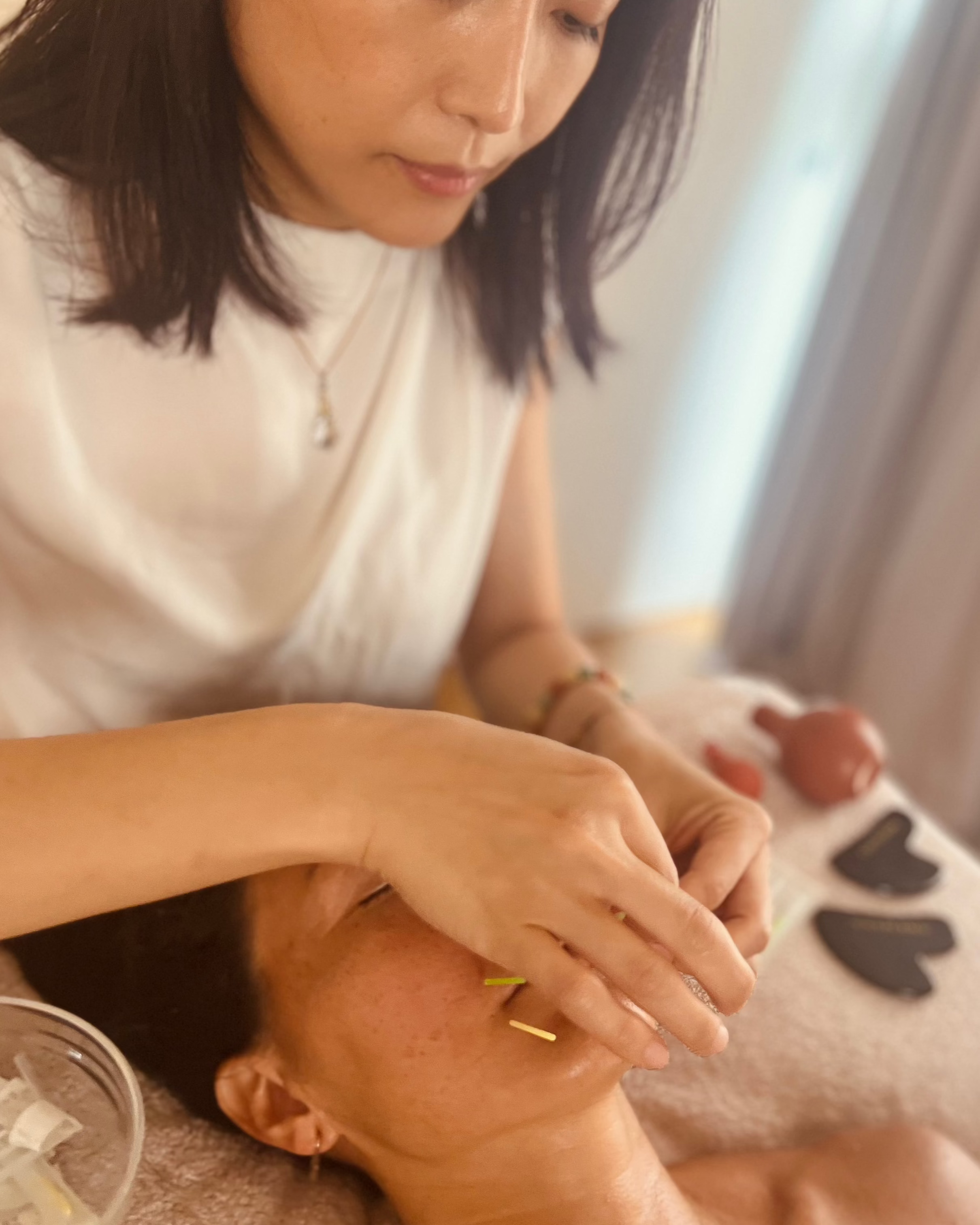 Acupuncture
