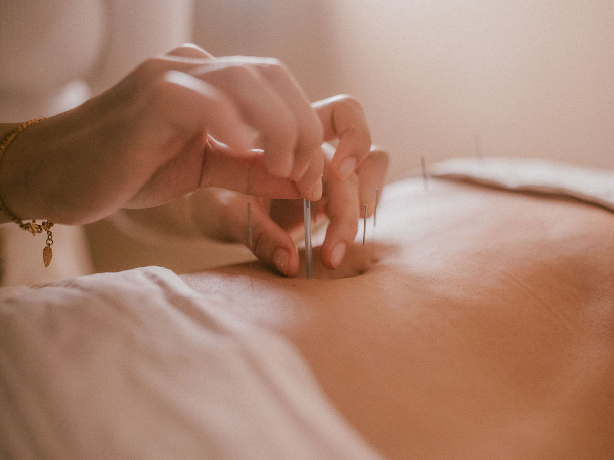 Acupuncture