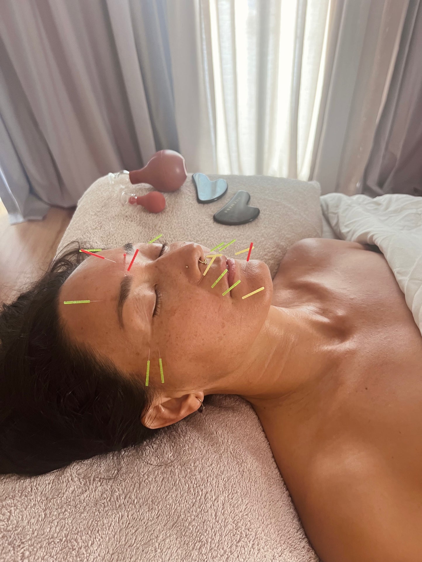 Beauty Acupuncture