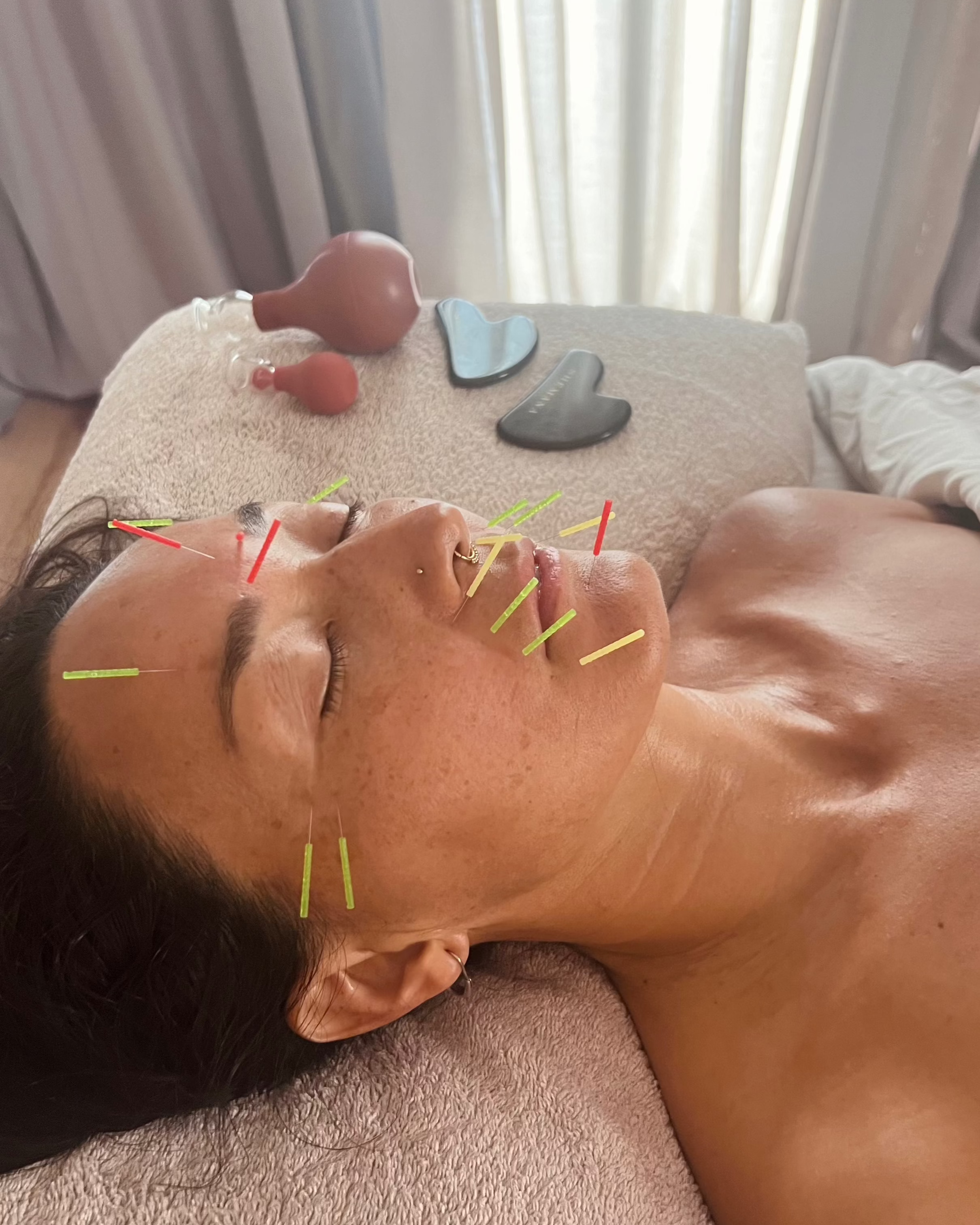 Beauty Acupuncture
