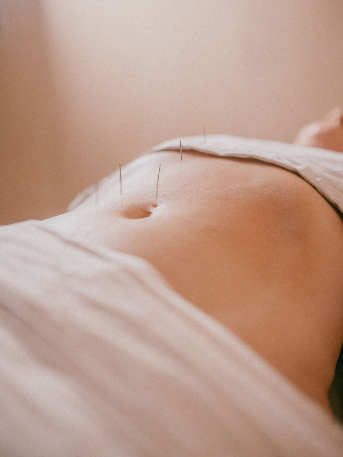 Acupuncture