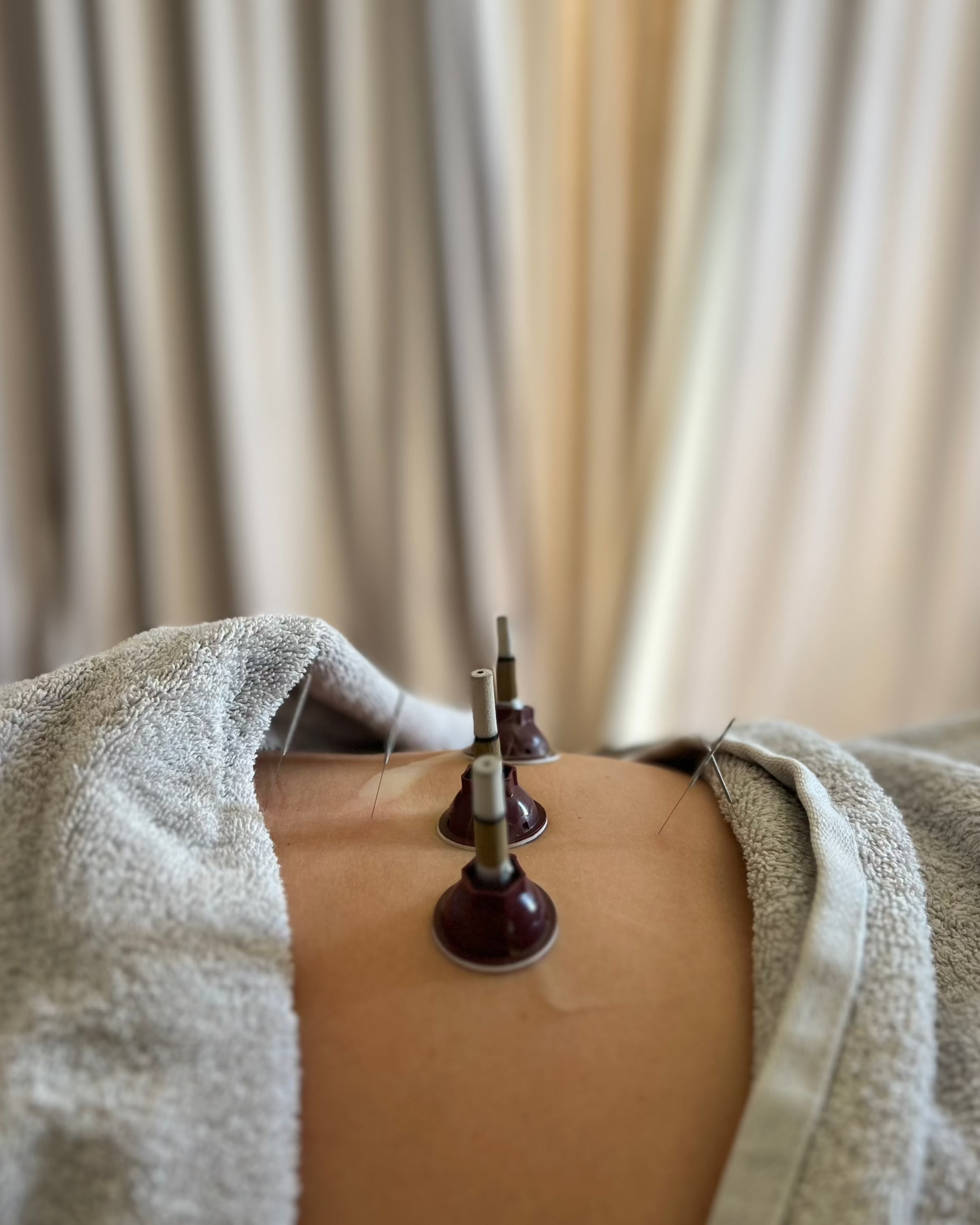 Acupuncture