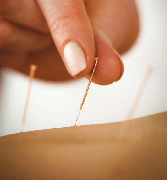 acupuncture pins on skin 